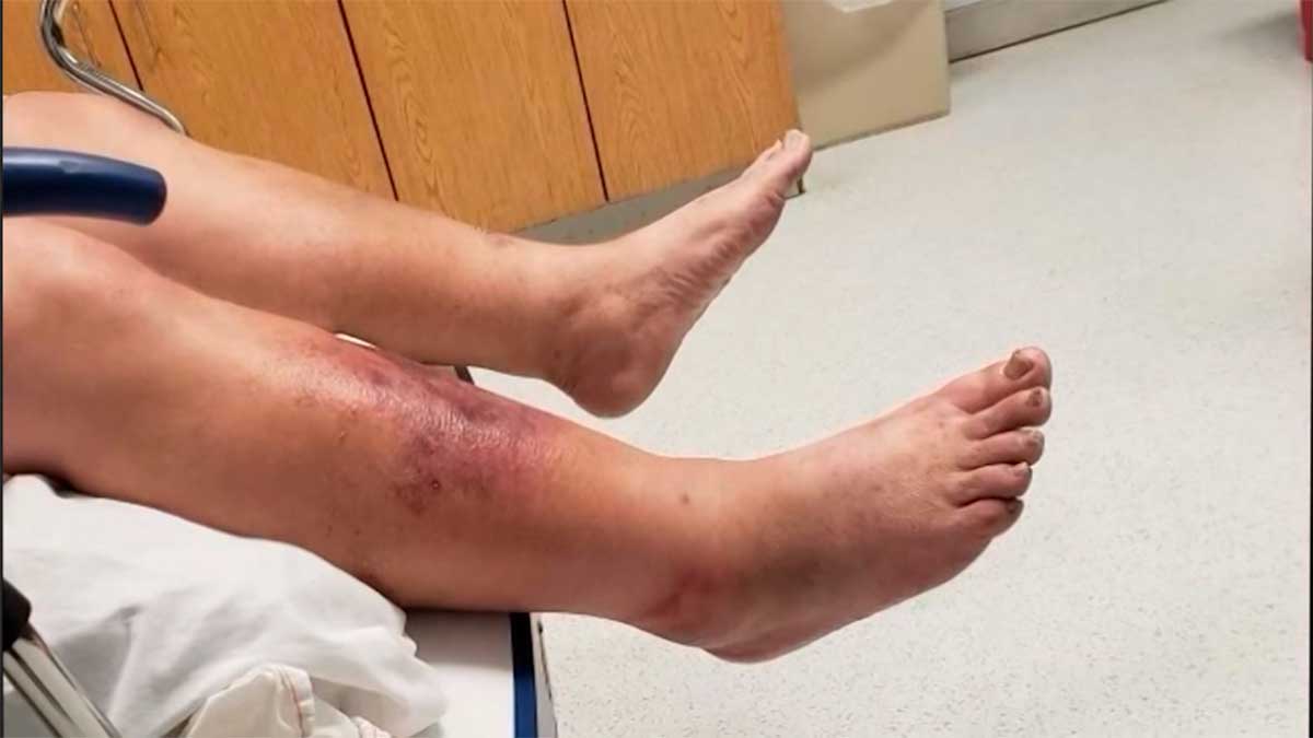 Alerta en Florida por bacteria carnívora: cuatro muertos en lo que va del año