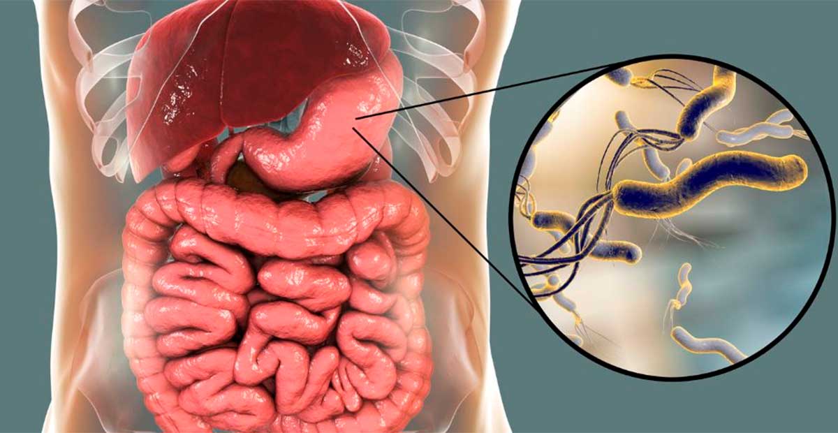 Helicobacter pylori, la bacteria silenciosa detrás de millones de casos de cáncer de estómago