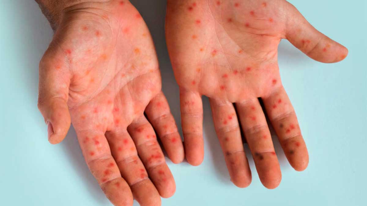 México: crisis sanitaria por brotes de sarampión, mpox y dengue