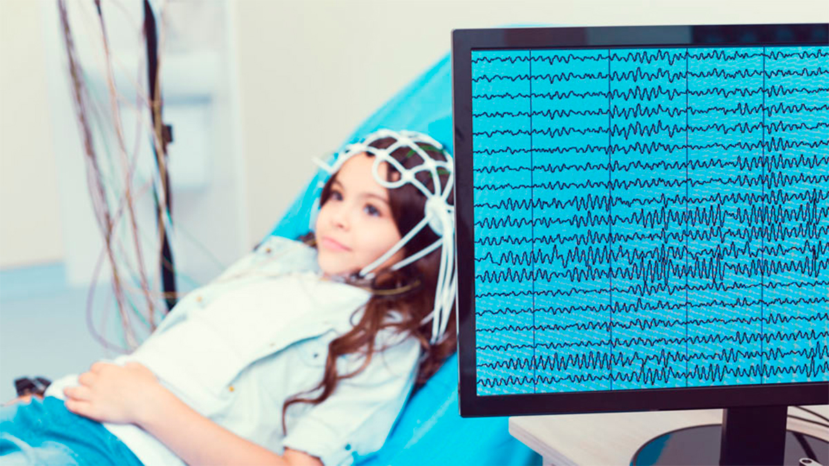 Inteligencia artificial revoluciona la detección de malformaciones cerebrales en niños con epilepsia