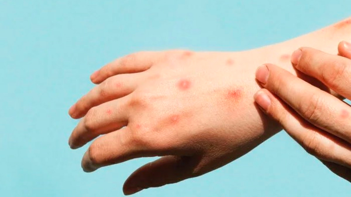 La OMS levanta la emergencia sanitaria internacional por Mpox