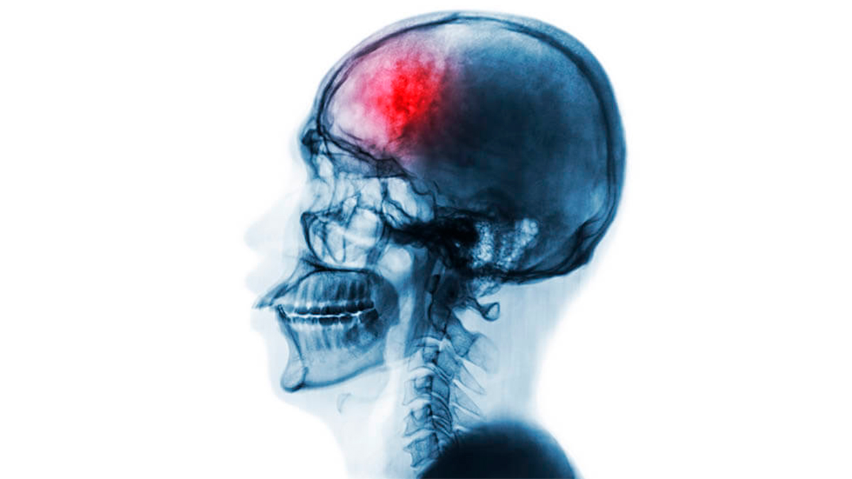 El estrés crónico puede dañar el cerebro y aumentar el riesgo de sufrir un accidente cerebrovascular
