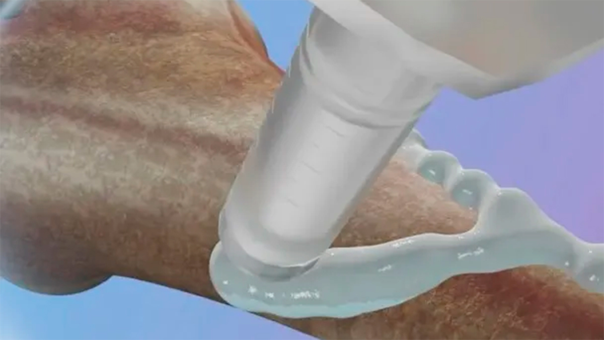 Científicos chinos crean un “pegamento para los huesos” que podría revolucionar el tratamiento de fracturas