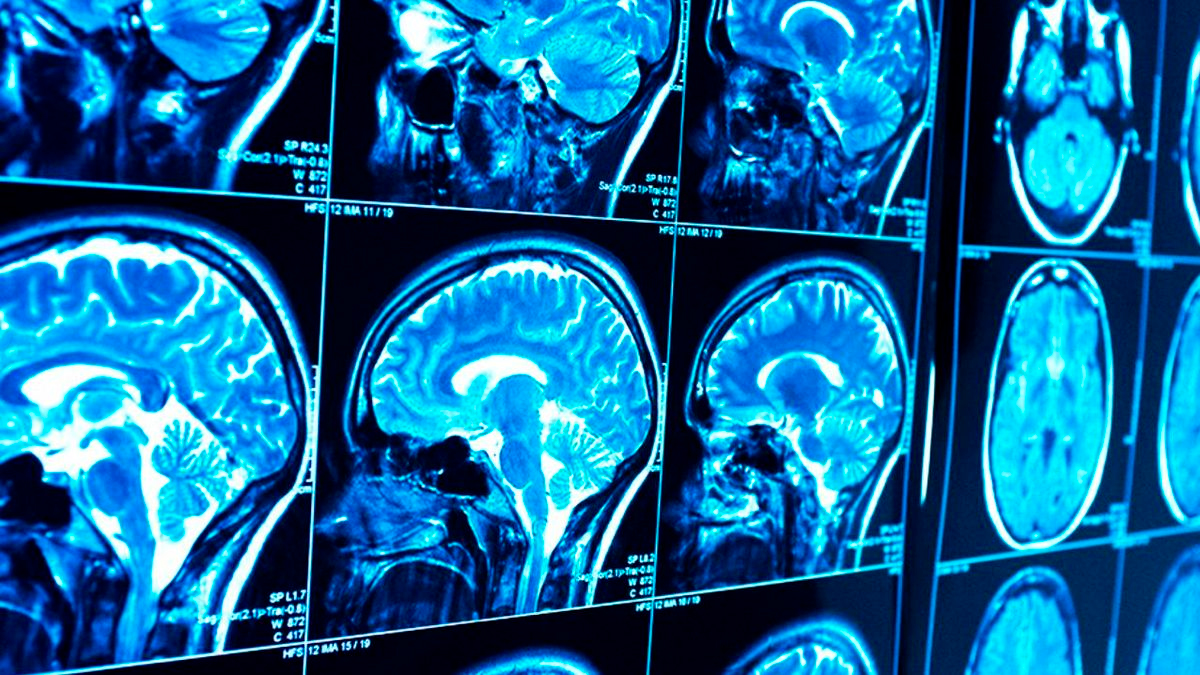 Beber en exceso puede provocar derrames cerebrales 11 años antes, advierte estudio publicado en Neurology