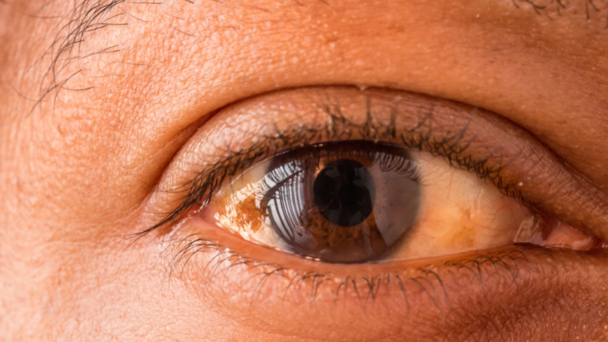 Alertan por subdiagnóstico de cáncer ocular en México; crean asociación especializada