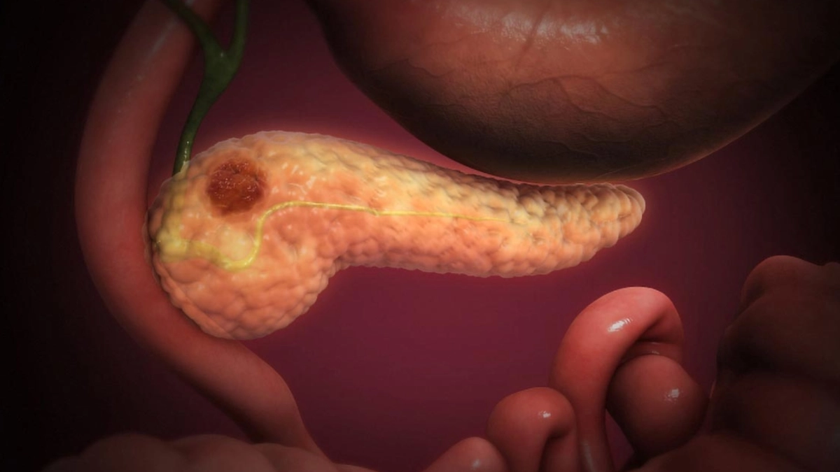 Científicos logran eliminar en ratones el cáncer de páncreas más agresivo con una innovadora terapia triple