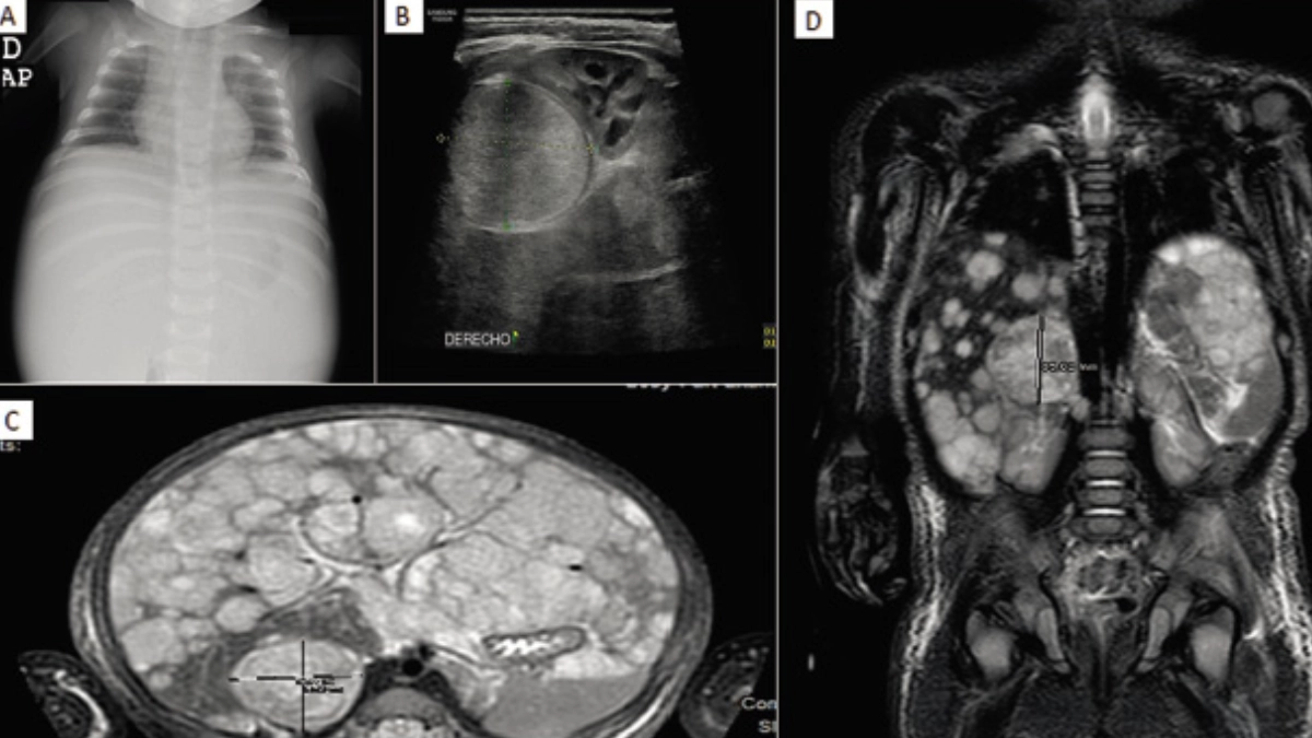 Nanotecnología y terapia celular abren una nueva vía contra el neuroblastoma infantil