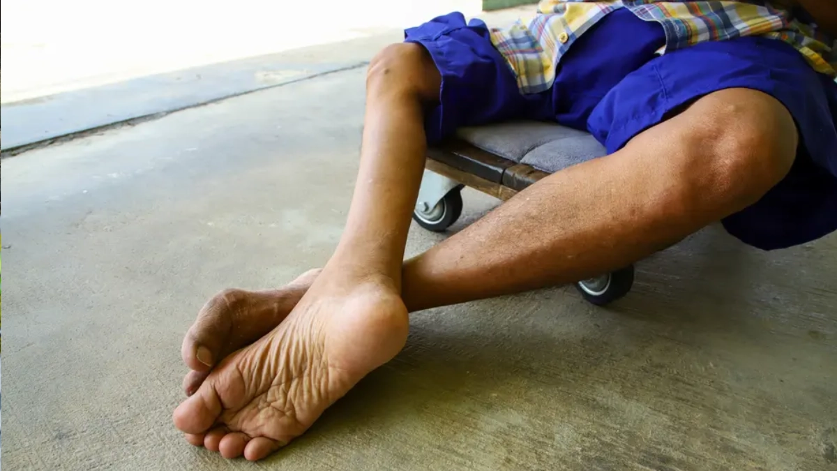 México cumple 35 años sin poliomielitis gracias a la vacunación universal