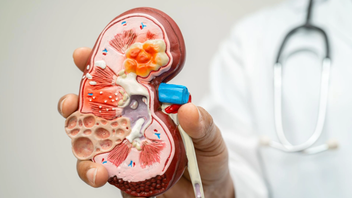 México, entre los países con más casos de enfermedad renal crónica en el mundo