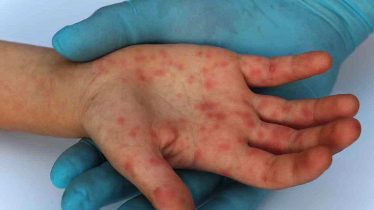 Jalisco y Chiapas encabezan brotes de sarampión al inicio de 2026