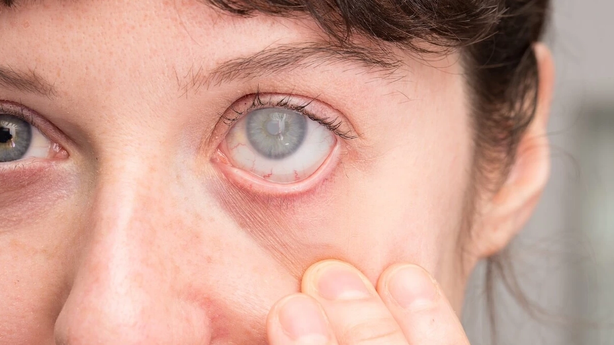 Casi la mitad de personas con cataratas no accede a cirugía: OMS