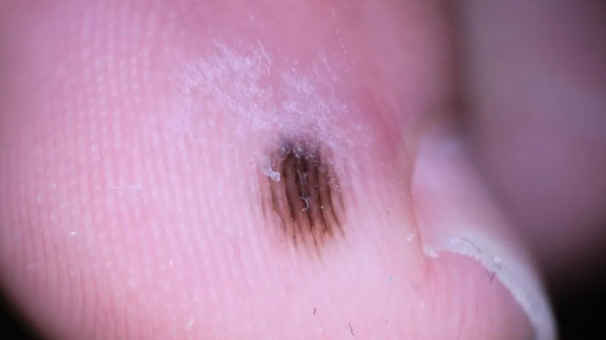 Científicas de la UNAM descubren claves genéticas del melanoma acral en población mexicana