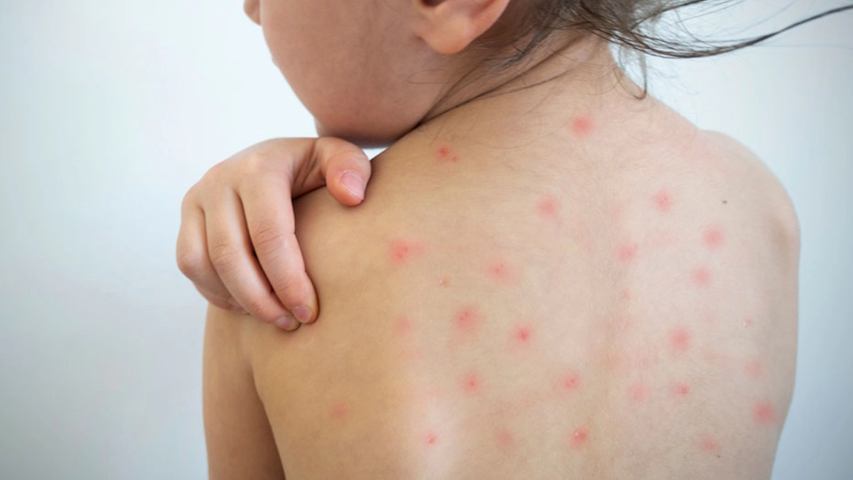 México concentra 71% de los casos de sarampión en América, alerta la OPS