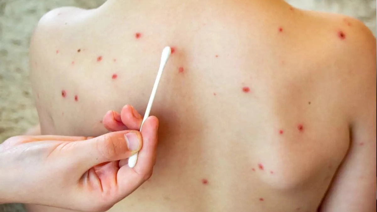 México lidera contagios de sarampión en América y enfrenta riesgo de perder estatus sanitario: OPS