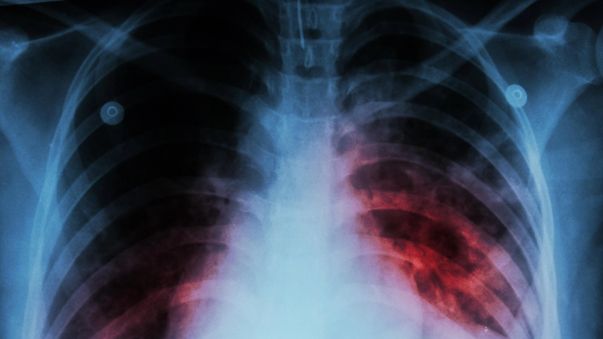Repuntan casos de tuberculosis respiratoria en México durante inicio de 2026
