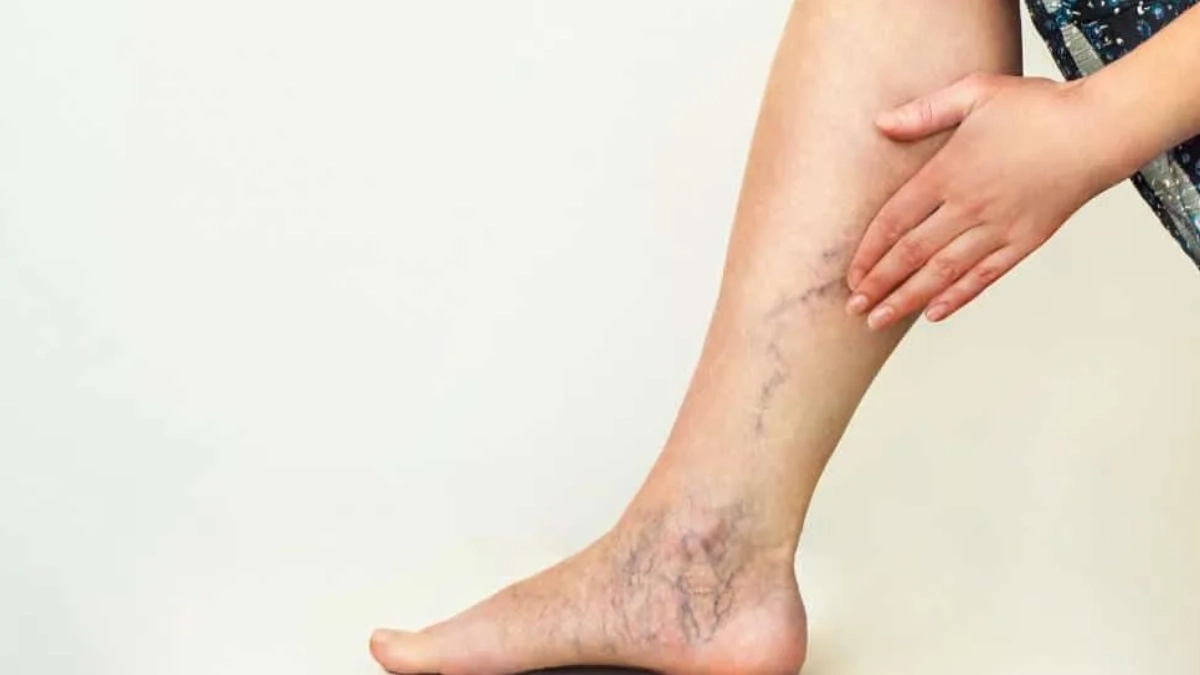 Siete de cada diez adultos en México podrían padecer enfermedad venosa crónica