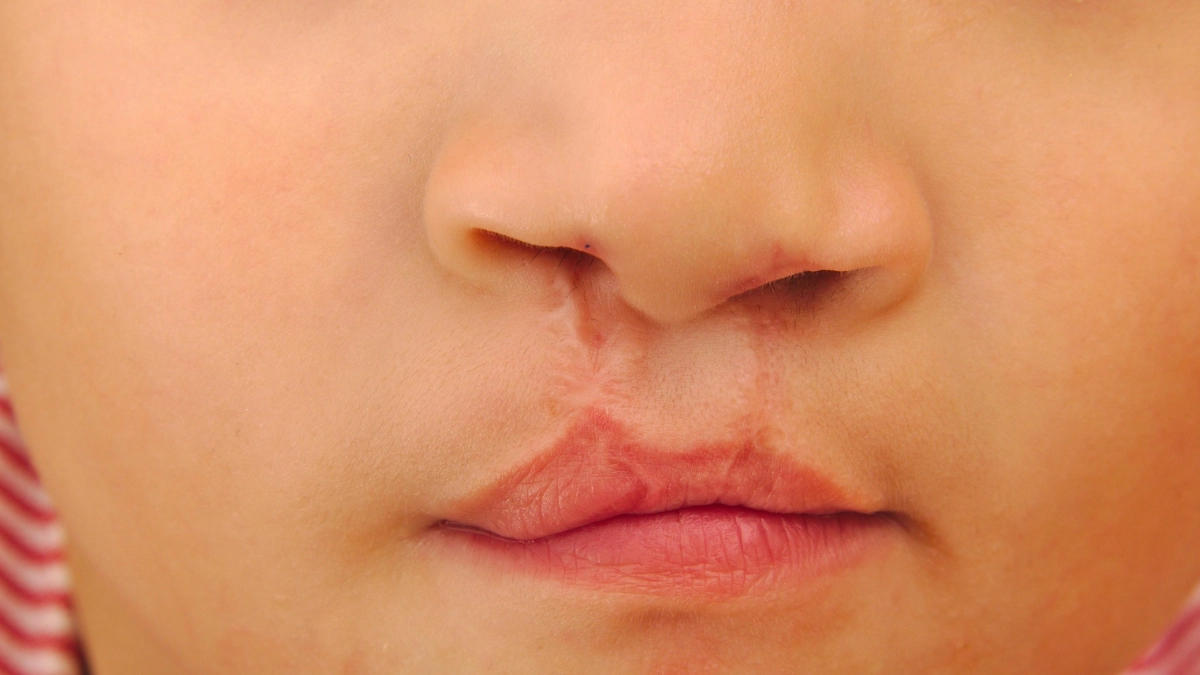 Labio hendido y cardiopatías, entre los defectos congénitos más frecuentes en México