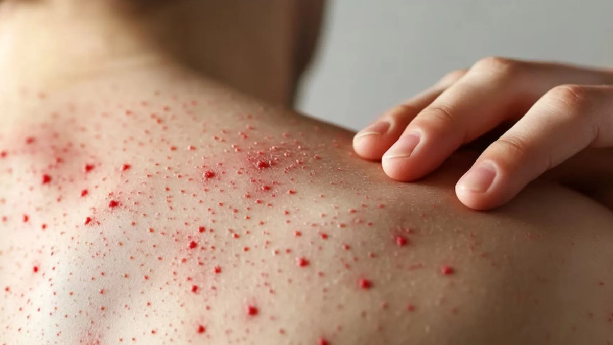 Gobierno reporta descenso en casos de sarampión tras aplicar más de 17 millones de vacunas