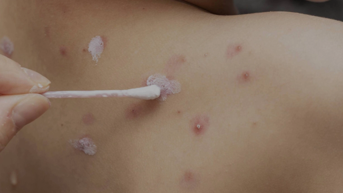 Virus de la varicela puede reactivarse décadas después y causar herpes zóster