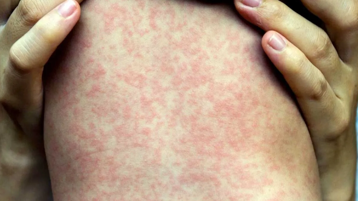 México supera los 15 mil casos de sarampión desde 2025; Jalisco concentra mayor número