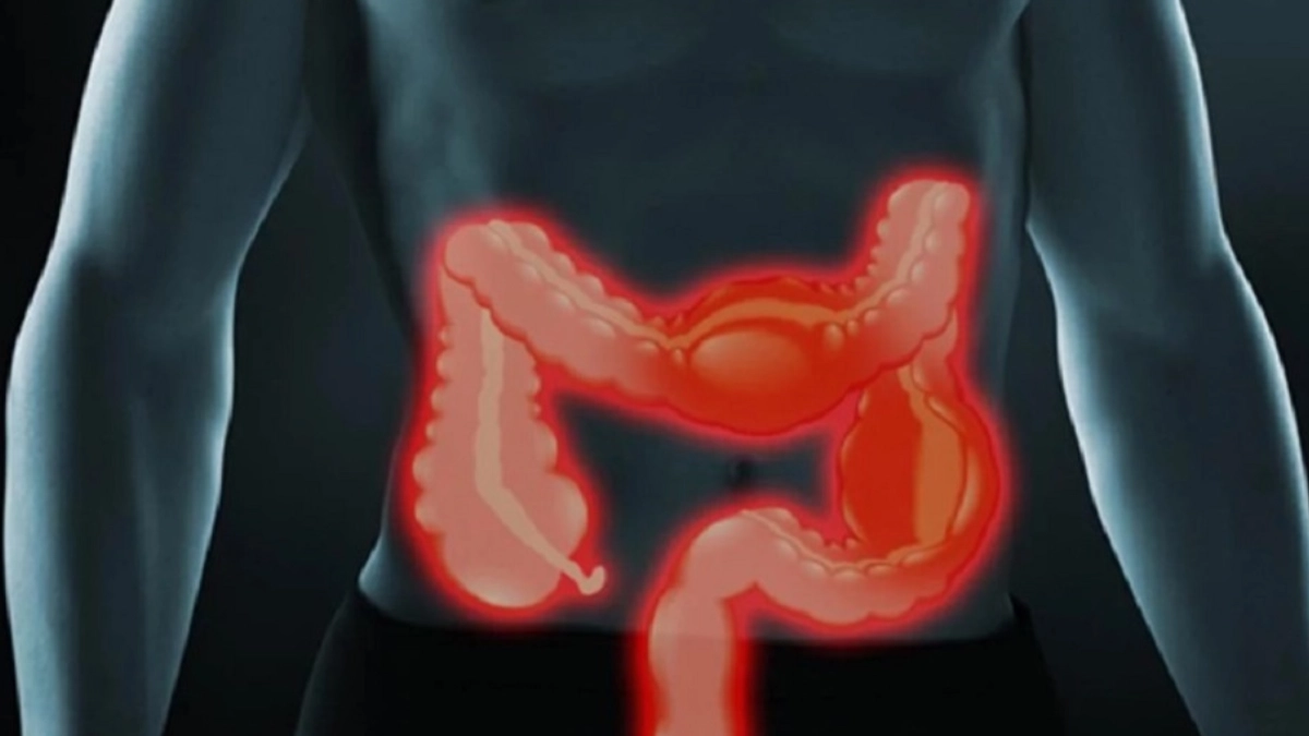 Alertan por aumento de enfermedad inflamatoria intestinal en México; síntomas suelen confundirse con otros padecimientos