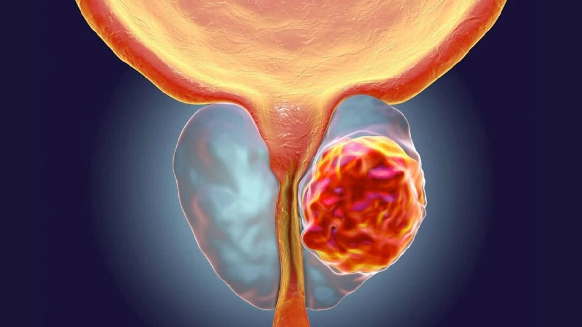Diagnóstico tardío agrava impacto del cáncer de próstata en México; especialistas llaman a reforzar la prevención