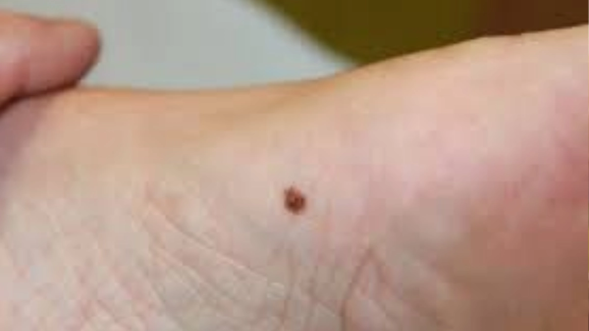 Científicos mexicanos avanzan en la búsqueda de tratamientos personalizados contra el melanoma acral