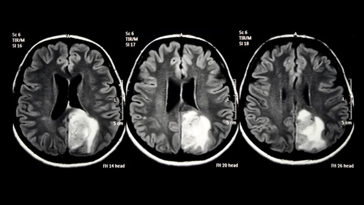 Nueva inmunoterapia muestra resultados prometedores contra el glioblastoma, el cáncer cerebral más agresivo