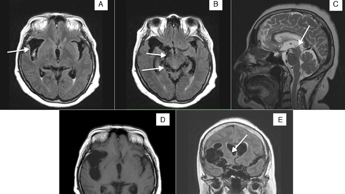Parásitos intestinales: una amenaza silenciosa que puede llegar al cerebro